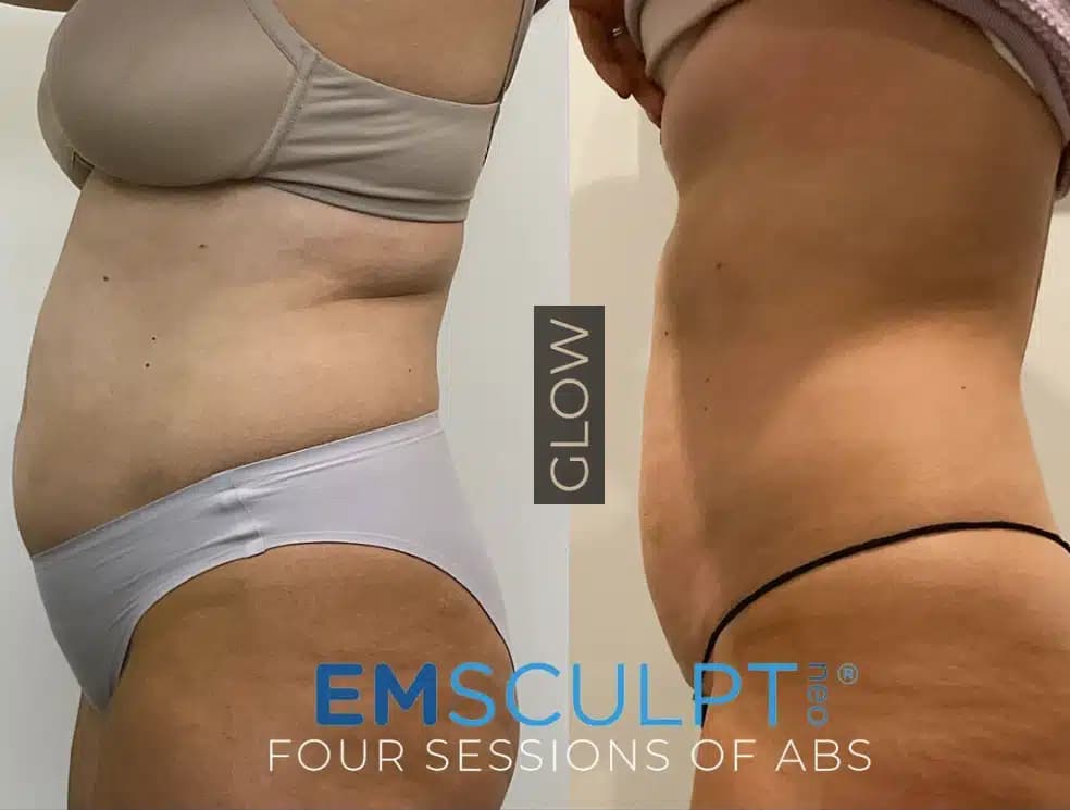 emsculpt by glow medical spa in franklin tn emsculpt by glow medical spa in franklin tn