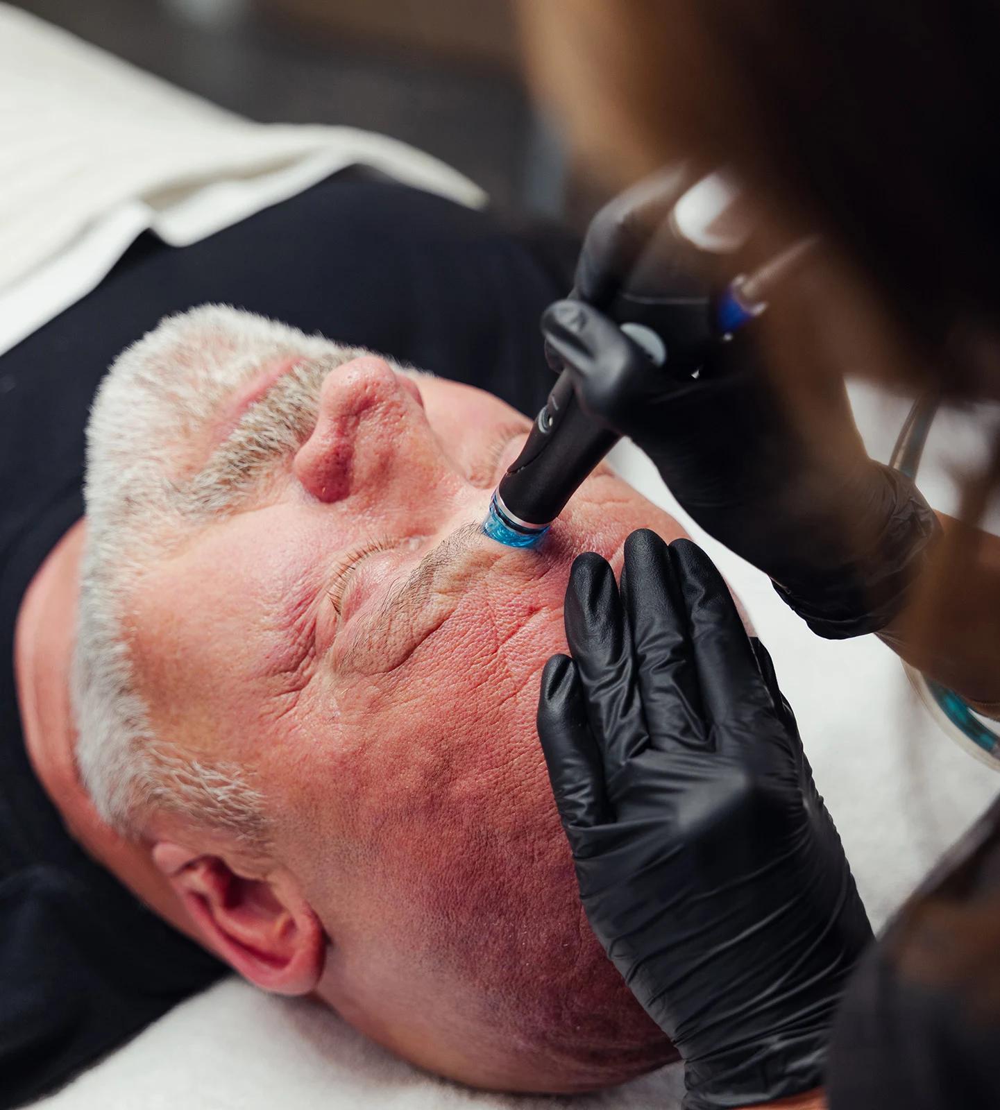 Close-up of a male client receiving a HydraFacial skin resurfacing treatment at a professional medical spa.