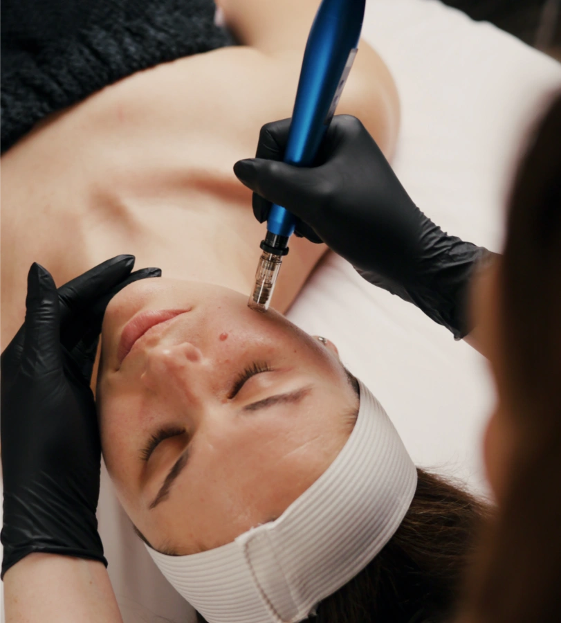esthetician giving microneedling treatment to patient at glow medical spa