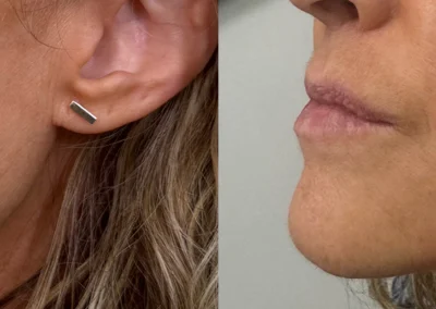 chin filler by glow medical spa in franklin tn