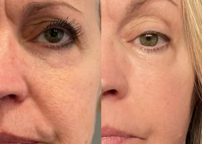 coolpeel laser by glow medical spa in franklin tn