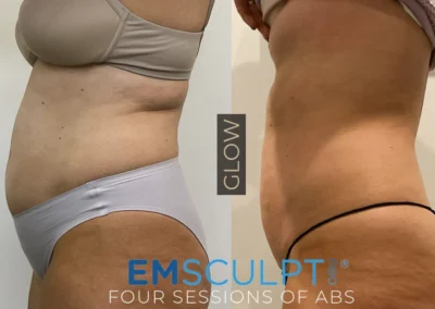 emsculpt by glow medical spa in franklin tn