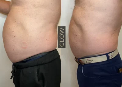 emsculpt neo by glow medical spa in franklin tn