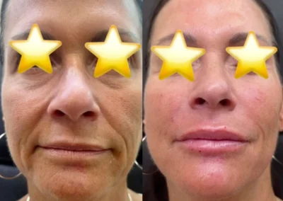 full face rejuvenation filler by glow medical spa in franklin tn