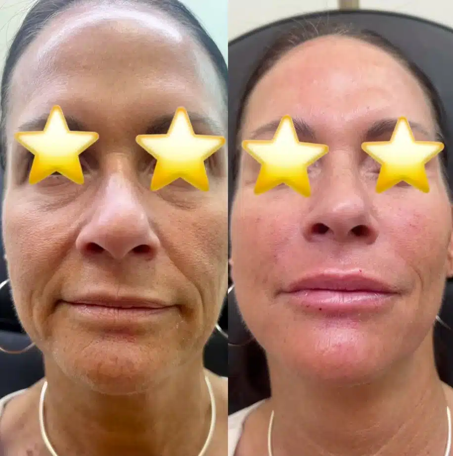 full face rejuvenation filler by glow medical spa in franklin tn