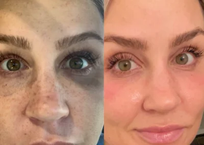 full Face skin rejuvenation aesthetic services by glow medical spa in franklin tn