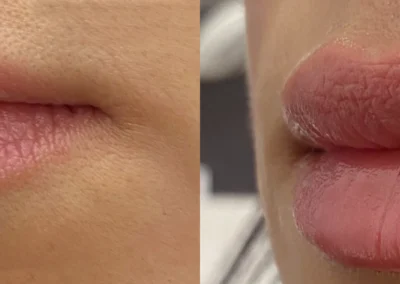 lip filler by glow medical spa in franklin tn