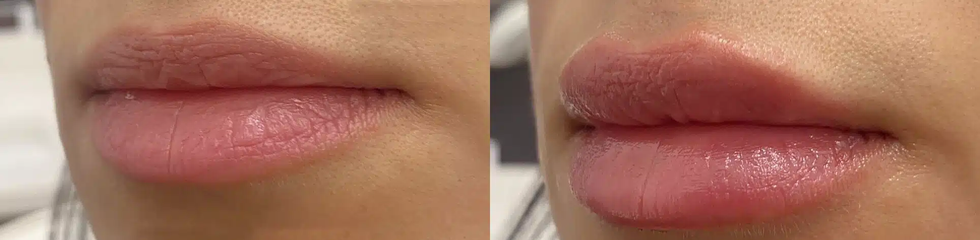 lip filler by glow medical spa in franklin tn