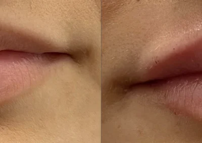 lip filler by glow medical spa in franklin tn