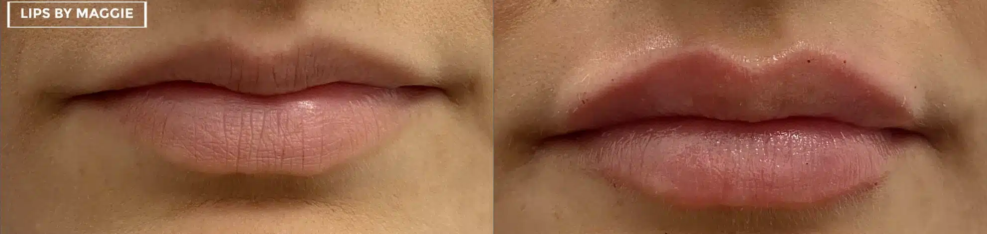 lip filler by glow medical spa in franklin tn