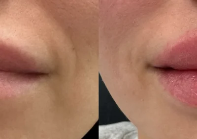 lip filler by glow medical spa in franklin tn