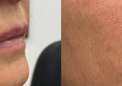 lip filler by glow medical spa in franklin tn