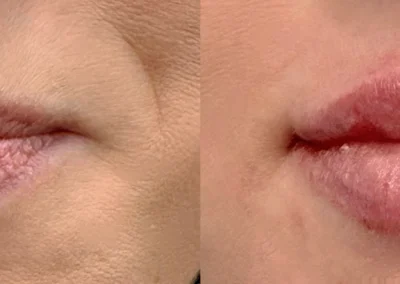 lip filler by glow medical spa in franklin tn