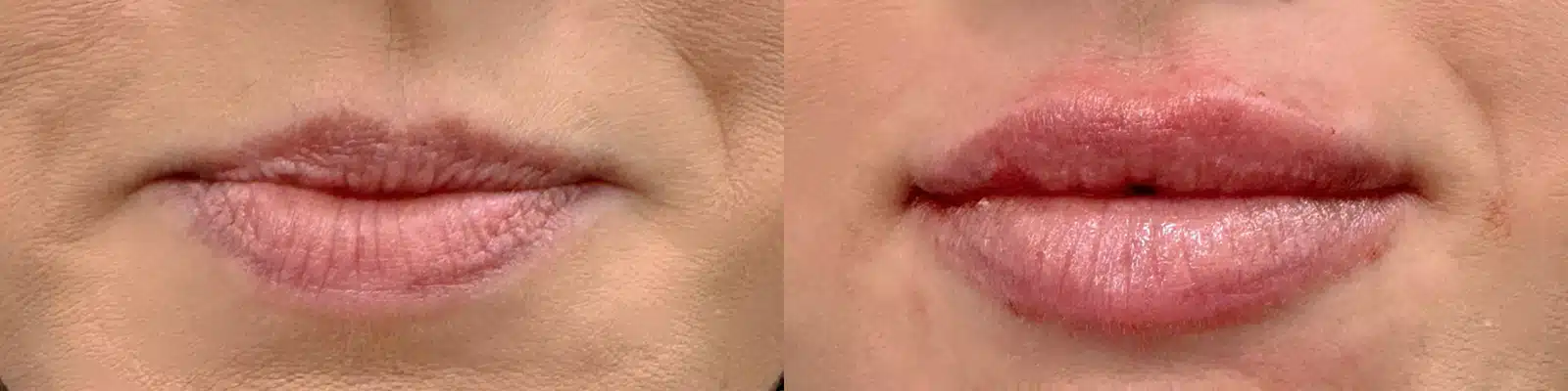 lip filler by glow medical spa in franklin tn