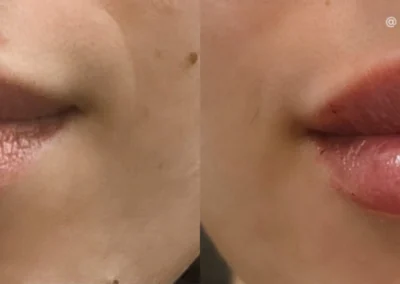 lip filler by glow medical spa in franklin tn