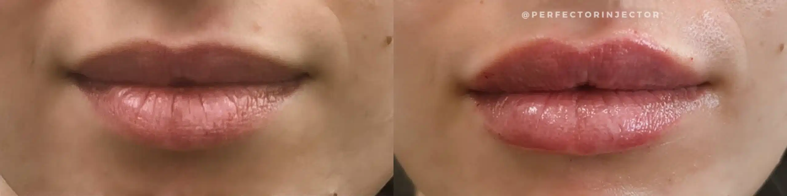 lip filler by glow medical spa in franklin tn