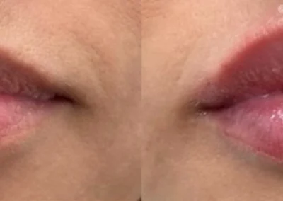 lip filler by glow medical spa in franklin tn