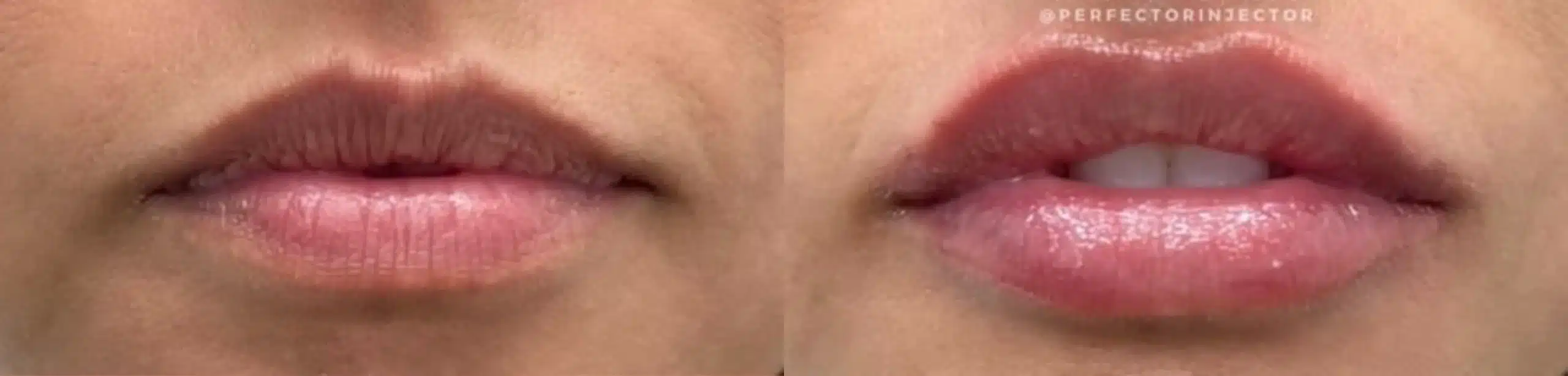 lip filler by glow medical spa in franklin tn