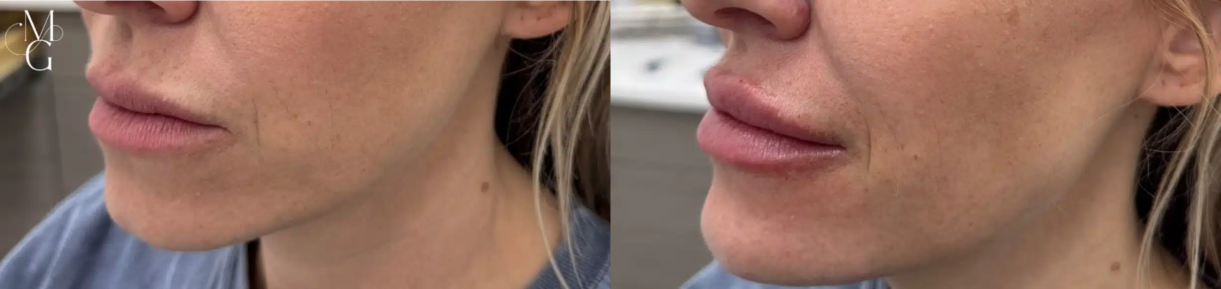 lip filler by glow medical spa in franklin tn