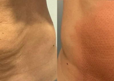 plasma pen by glow medical spa in franklin tn