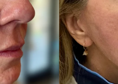 sculptra by glow medical spa in franklin tn
