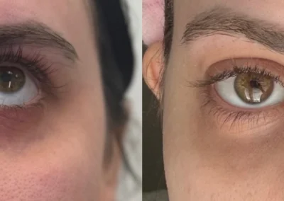 under eye pdgf by glow medical spa in franklin tn