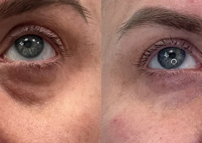 under eye rejuvenation by glow medical spa in franklin tn