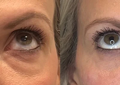 under eye rejuvenation by glow medical spa in franklin tn