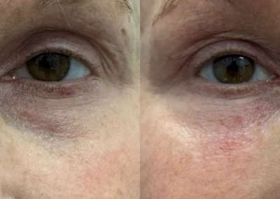 under eye rejuvenation pdgf by glow medical spa in franklin tn