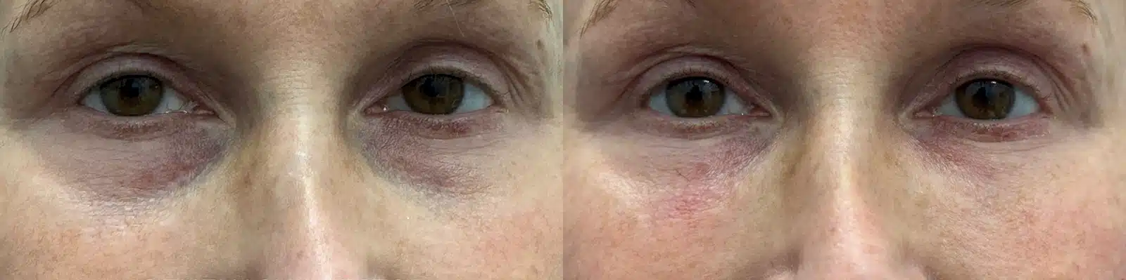 under eye rejuvenation pdgf by glow medical spa in franklin tn
