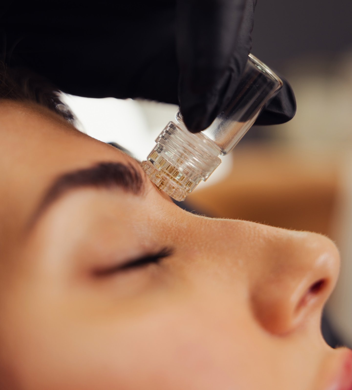 woman receiving exosome treamtment at glow medspa