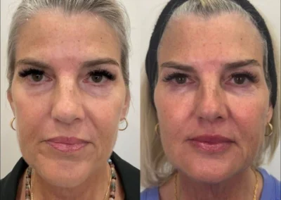 before and after facial balancing by glow medical spa in franklin tn
