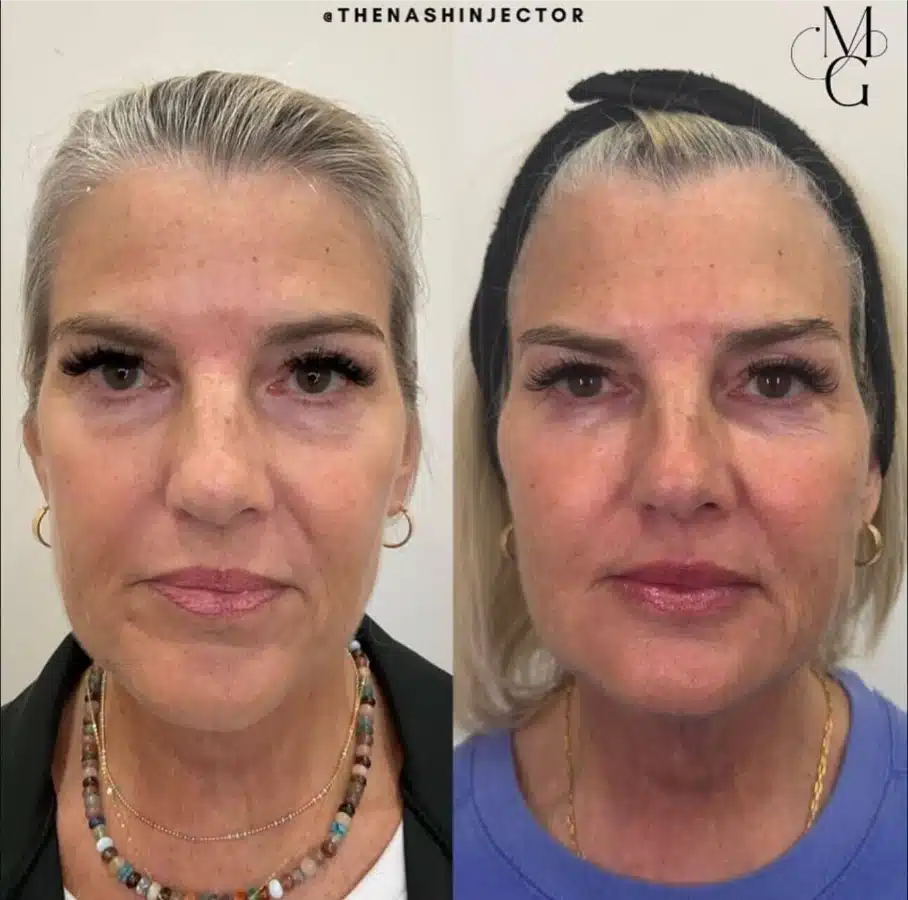 before and after facial balancing by glow medical spa in franklin tn